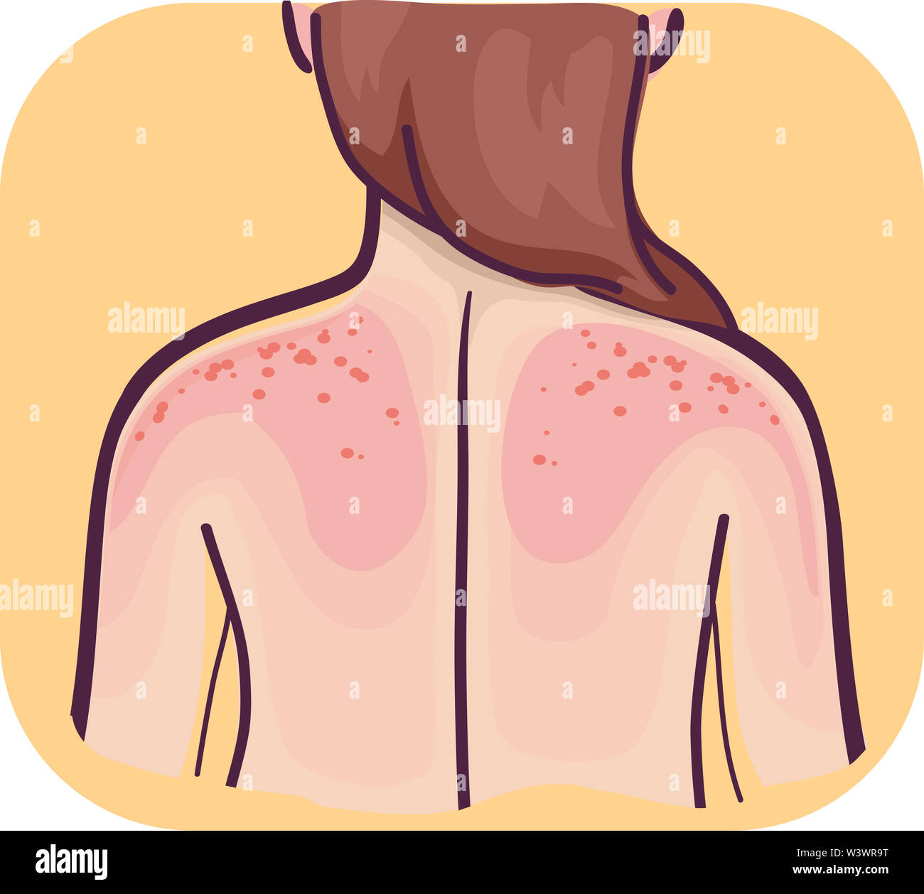 Abbildung: ein Mädchen ihr wieder mit empfindlicher Haut mit Sonnenbrand angezeigt Stockfoto