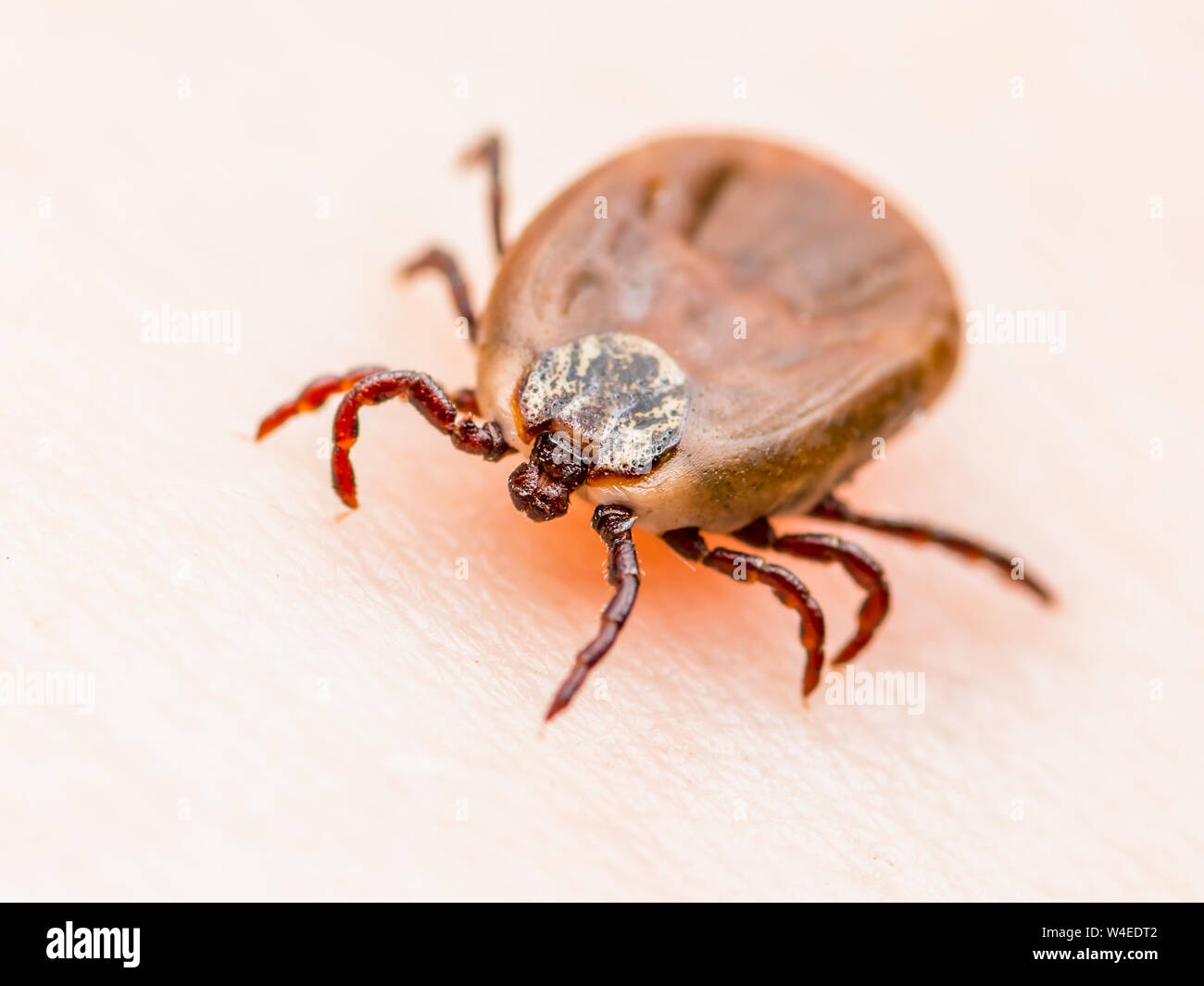Enzephalitis Virus oder Lyme Krankheit infizierten Zecke Dermacentor Spinne Insekt auf der Haut Makro Stockfoto