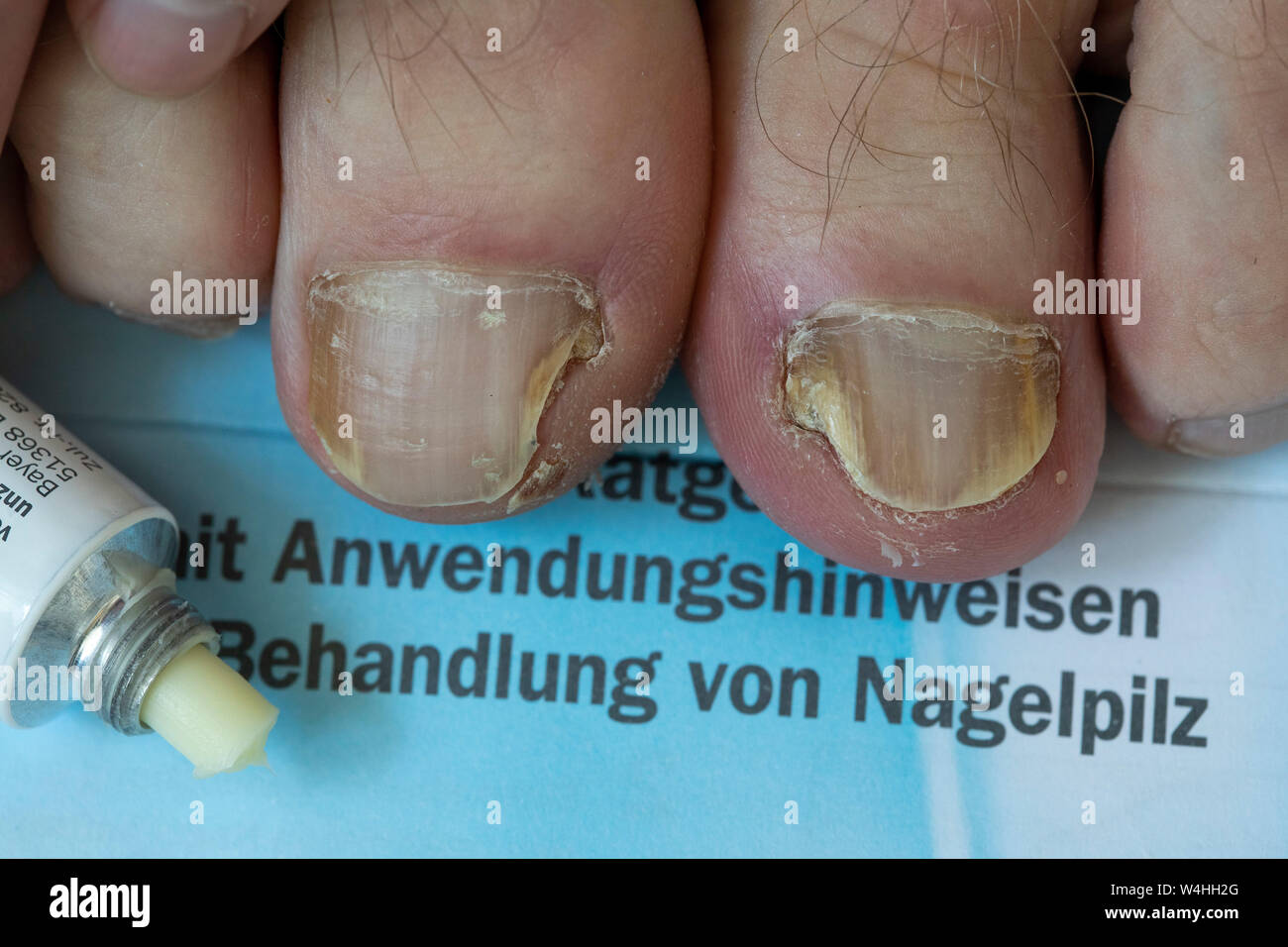 Fe, Zehenngel, mit Nagelpilz Befall, Salbe, anit Pilz Salbe  Stockfotografie - Alamy