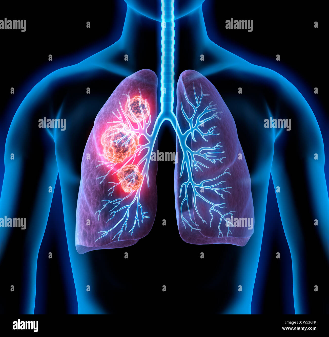 Menschliche Körper - Lungen mit Tumoren - 3D-Darstellung Stockfoto