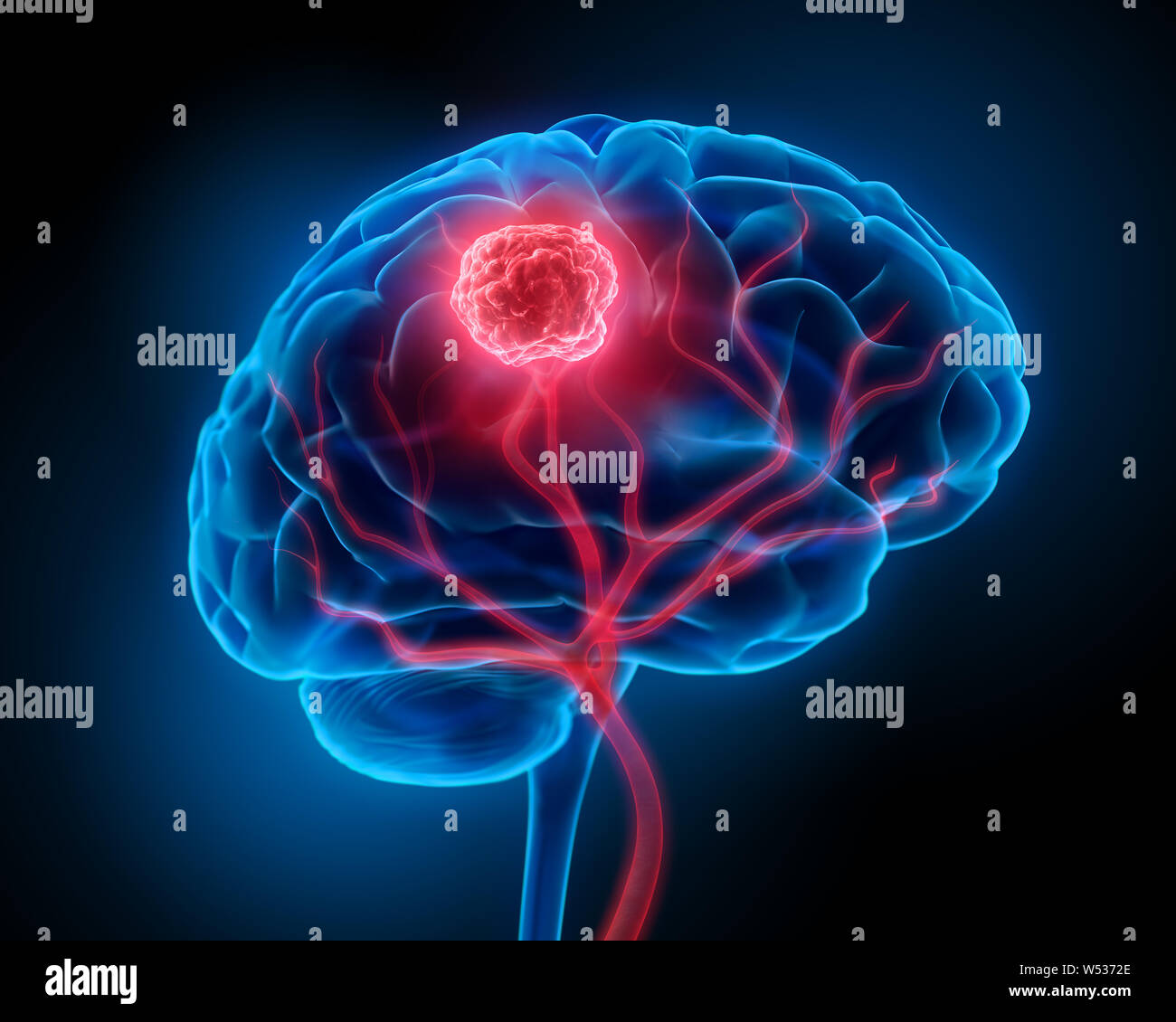 Gehirn mit Blutgefäßen und Tumor - 3D-Darstellung Stockfoto