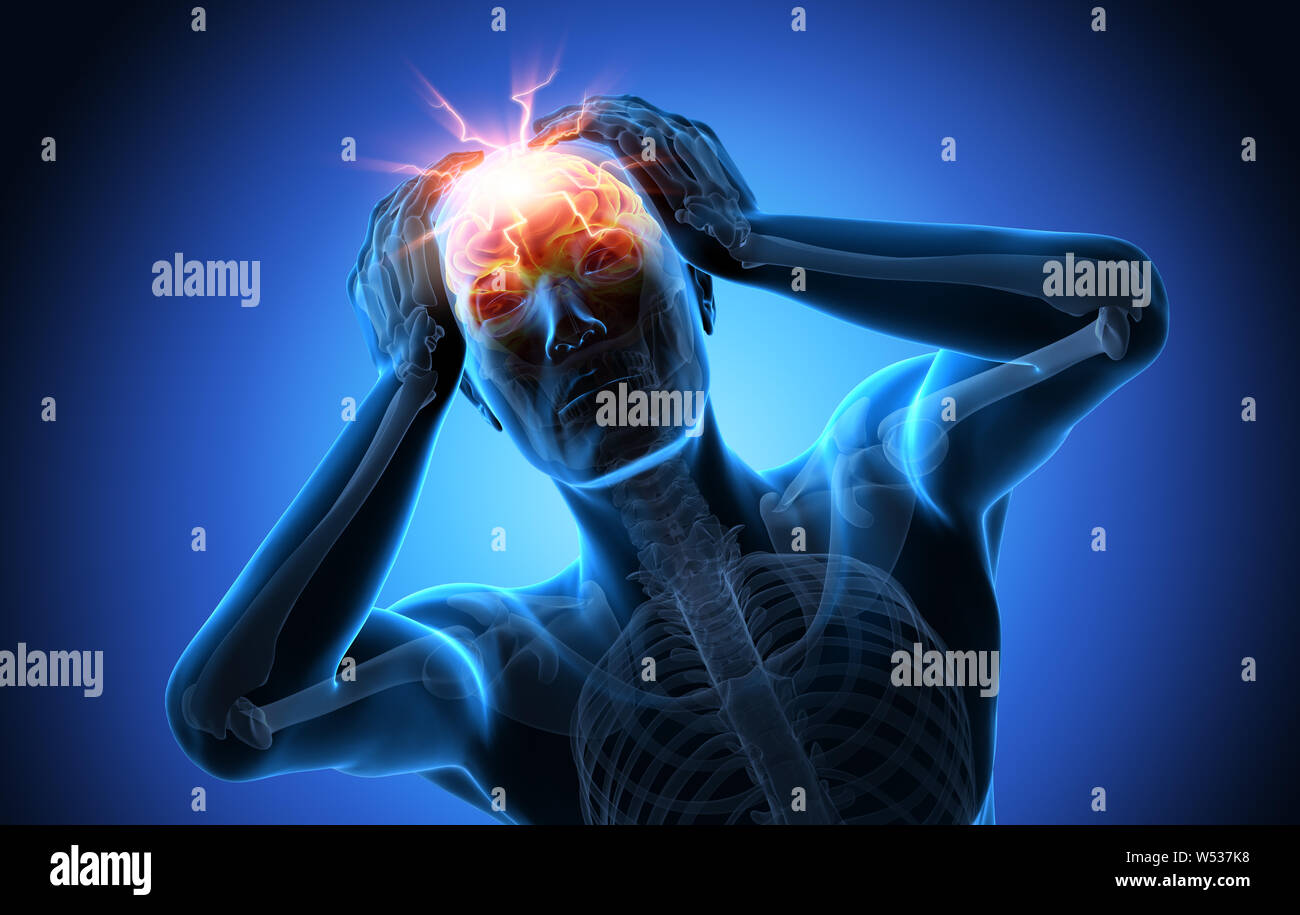 Menschen mit starken Kopfschmerzen-Hub-3D-Darstellung Stockfotografie