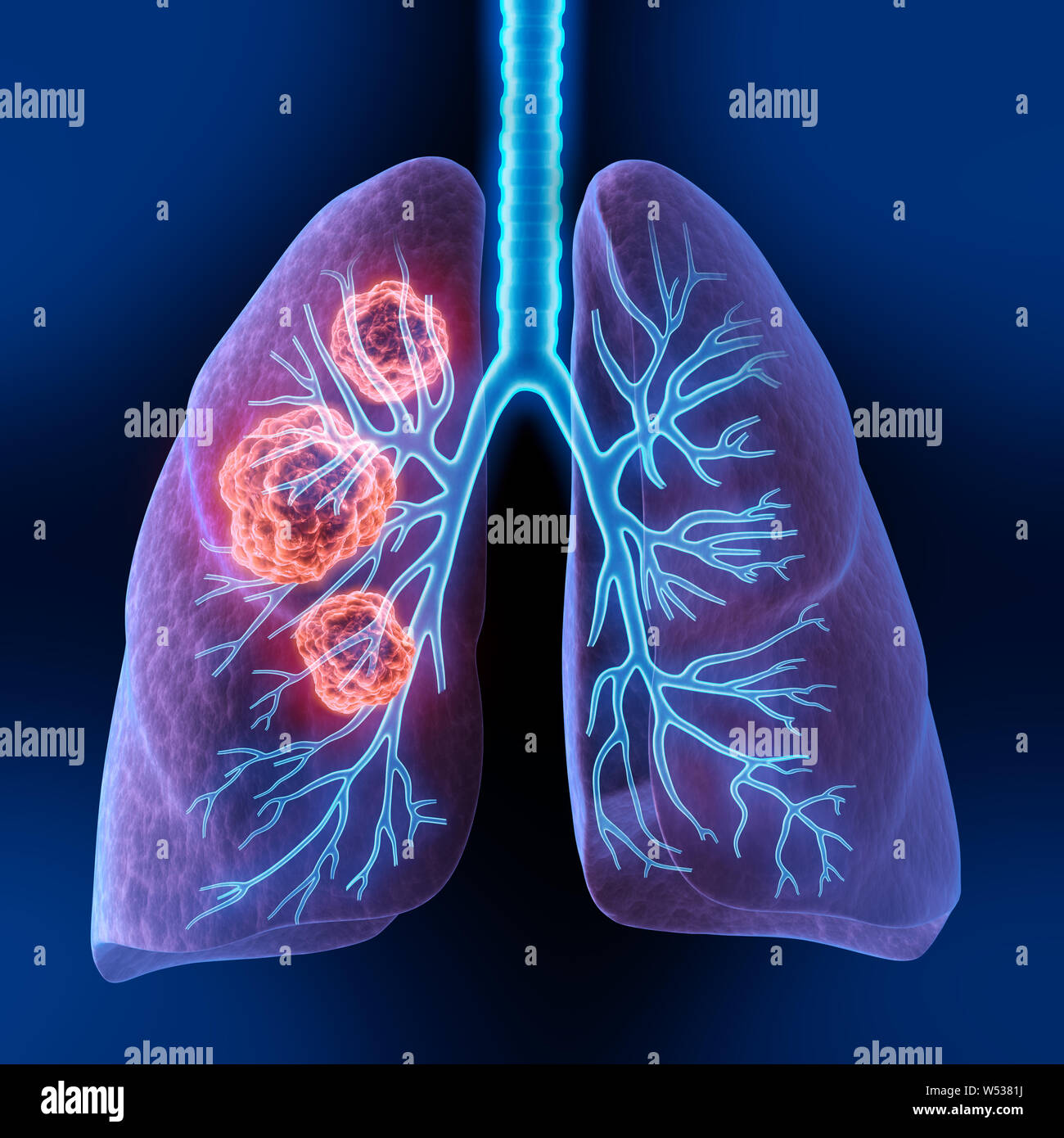 Menschliche Körper - Lungen mit Tumoren - 3D-Illustration - 3D-Darstellung Stockfoto