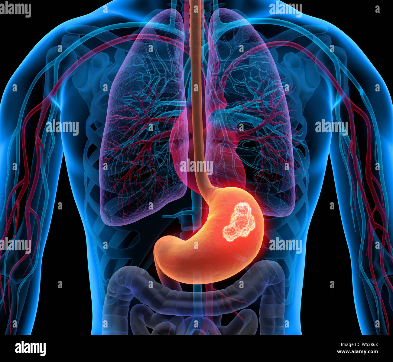 Krebs - Magen Tumor - 3D-Darstellung Stockfoto