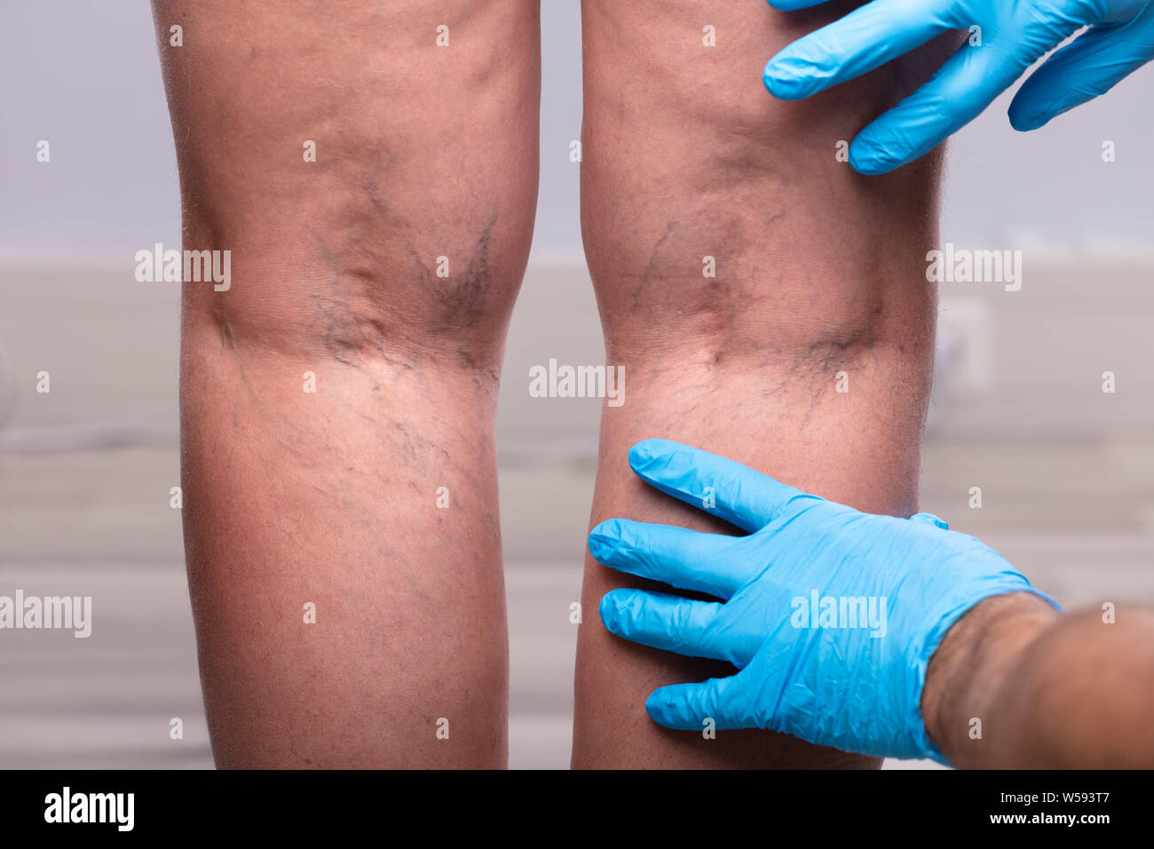 Medic mit blauen Latex OP-Handschuhe berühren Krampfadern am Bein des Patienten Stockfoto