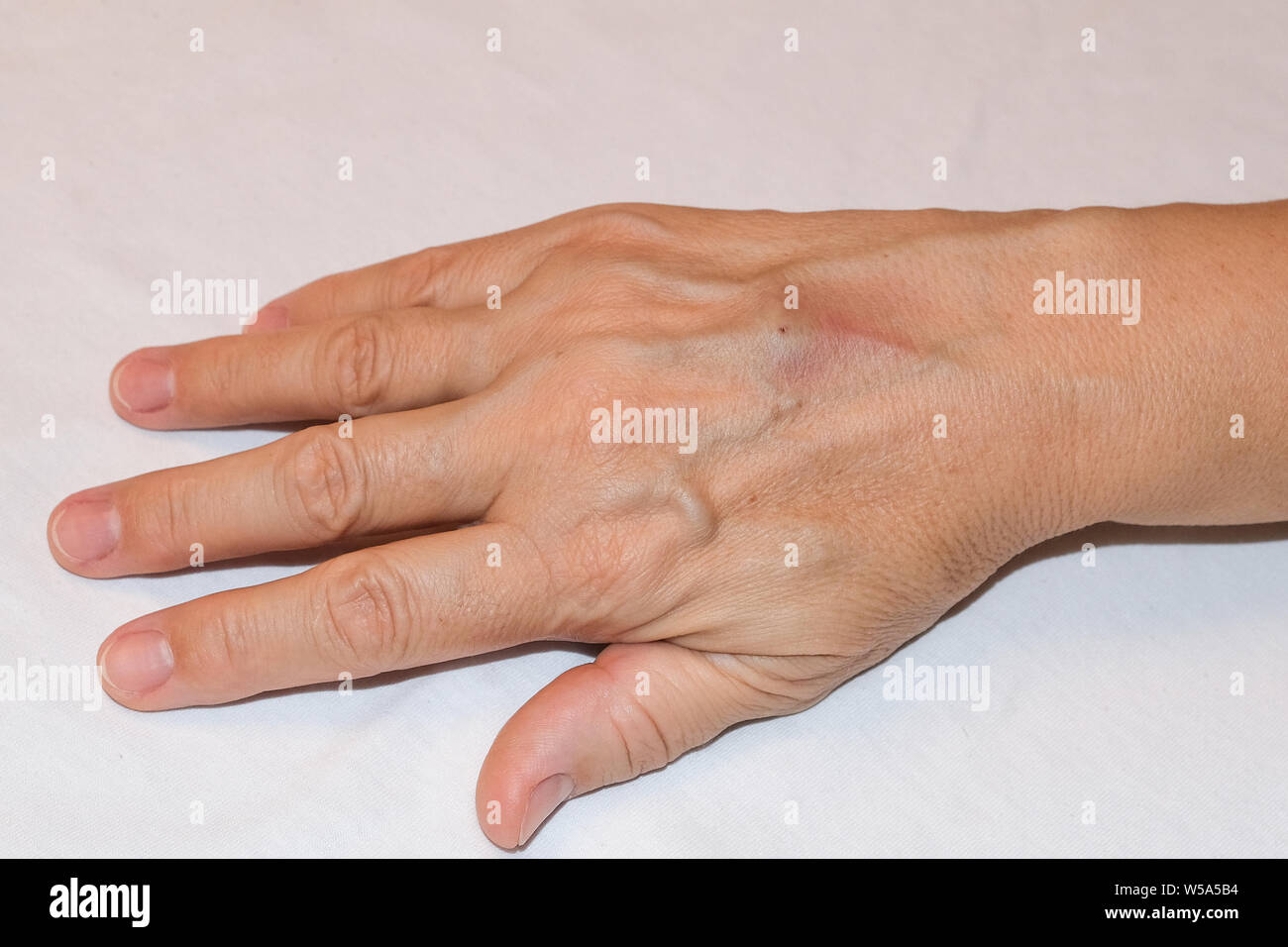 Die Folgen der Infusion mit fragilen oder Sklerotisches Venen am Arm Stockfoto