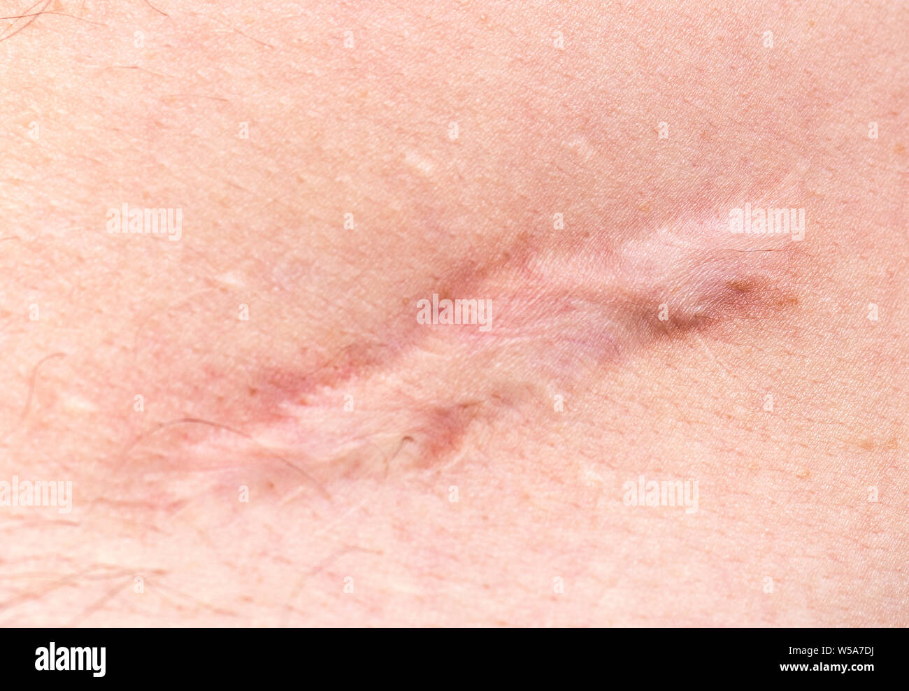 Narbe auf der menschlichen Haut Narbe oder cicatrice nach Betrieb Magen Stockfoto