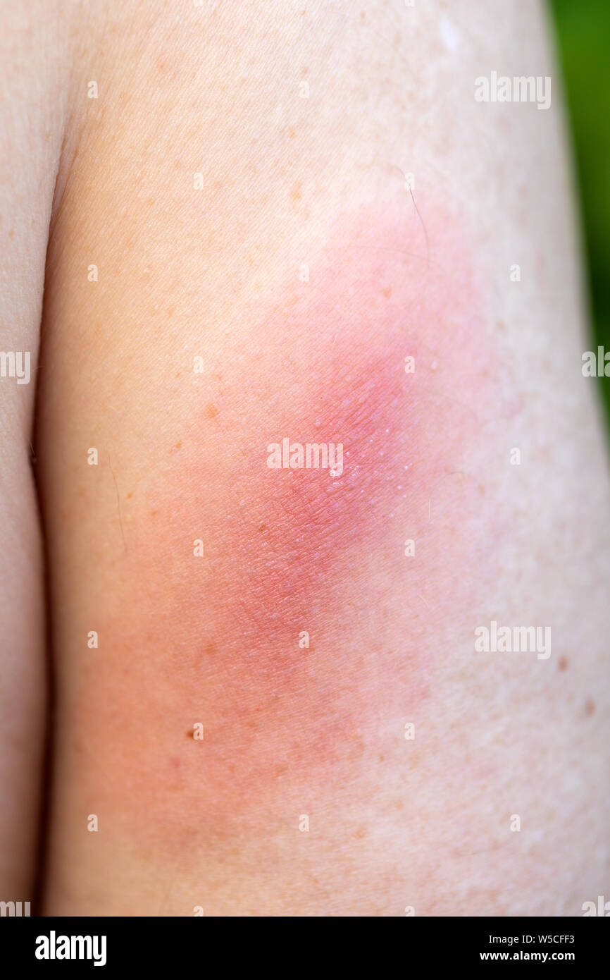 In der Nähe Bild von Lyme Fleck auf der menschlichen Haut - Borrelia, Borreliose durch Zecken (Ixodes ricinus) Stockfoto
