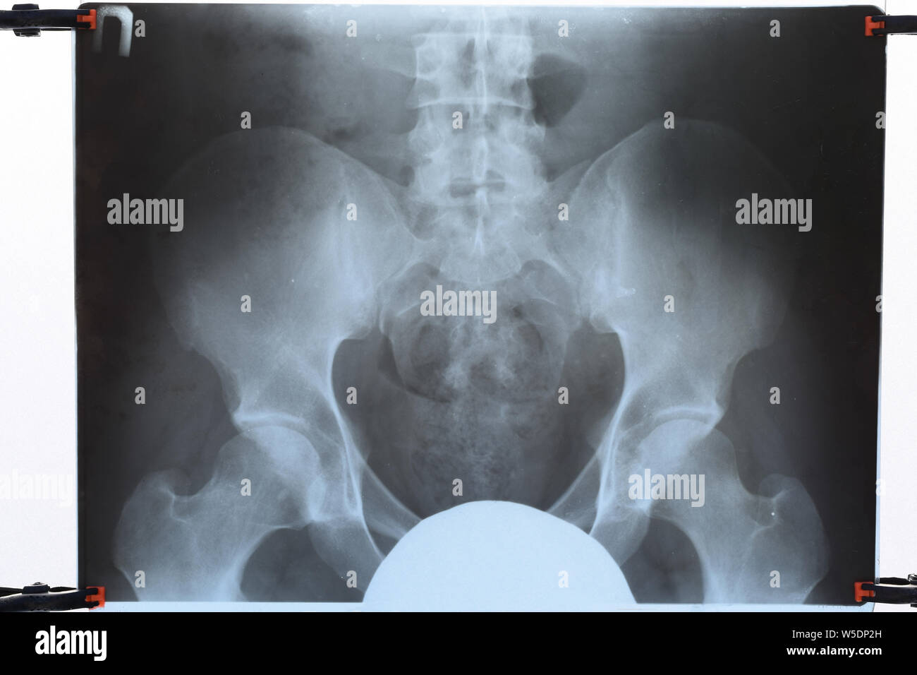 X-ray von Becken und Kreuzbein. X-ray Image. Stockfoto