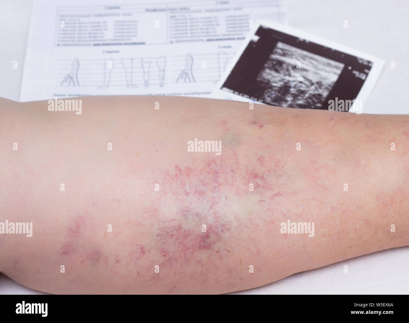Bein von einer alten Frau, Krampfadern, Nahaufnahme,  Ultraschalluntersuchung Dokumente, phlebeurysm, Thrombose, Problem  Stockfotografie - Alamy