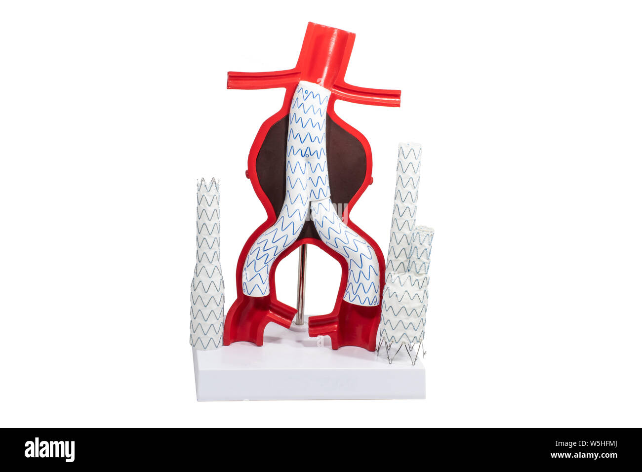 Modell Aneurysma Behandlung mit Endovaskuläre verglaste und verzweigten Stent-Transplantationen. Stockfoto