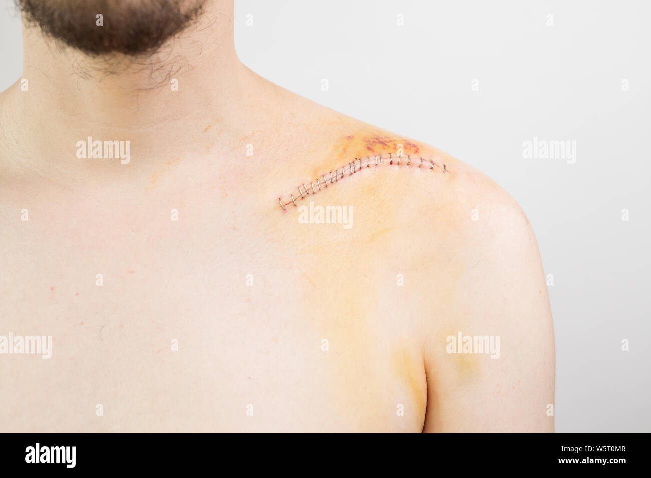 Gebrochene Schlüsselbein/Schlüsselbein/clavicula nach der Operation nach einem Fahrrad crash Stockfoto