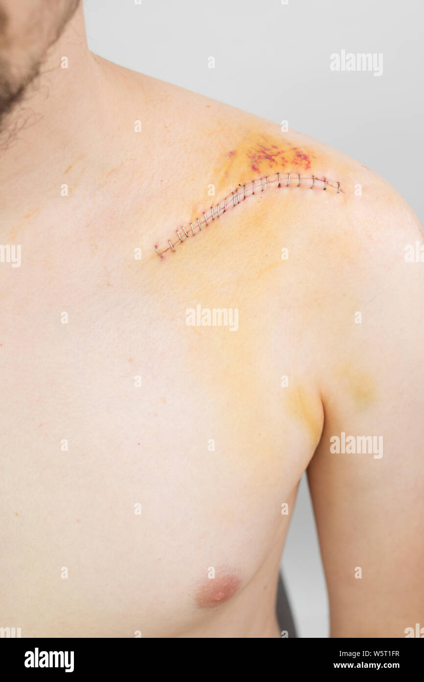 Gebrochene Schlüsselbein/Schlüsselbein/clavicula nach der Operation nach einem Fahrrad crash Stockfoto