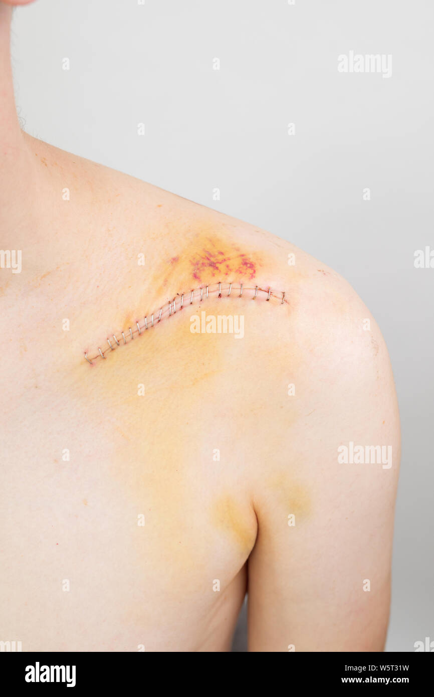 Gebrochene Schlüsselbein/Schlüsselbein/clavicula nach der Operation nach einem Fahrrad crash Stockfoto