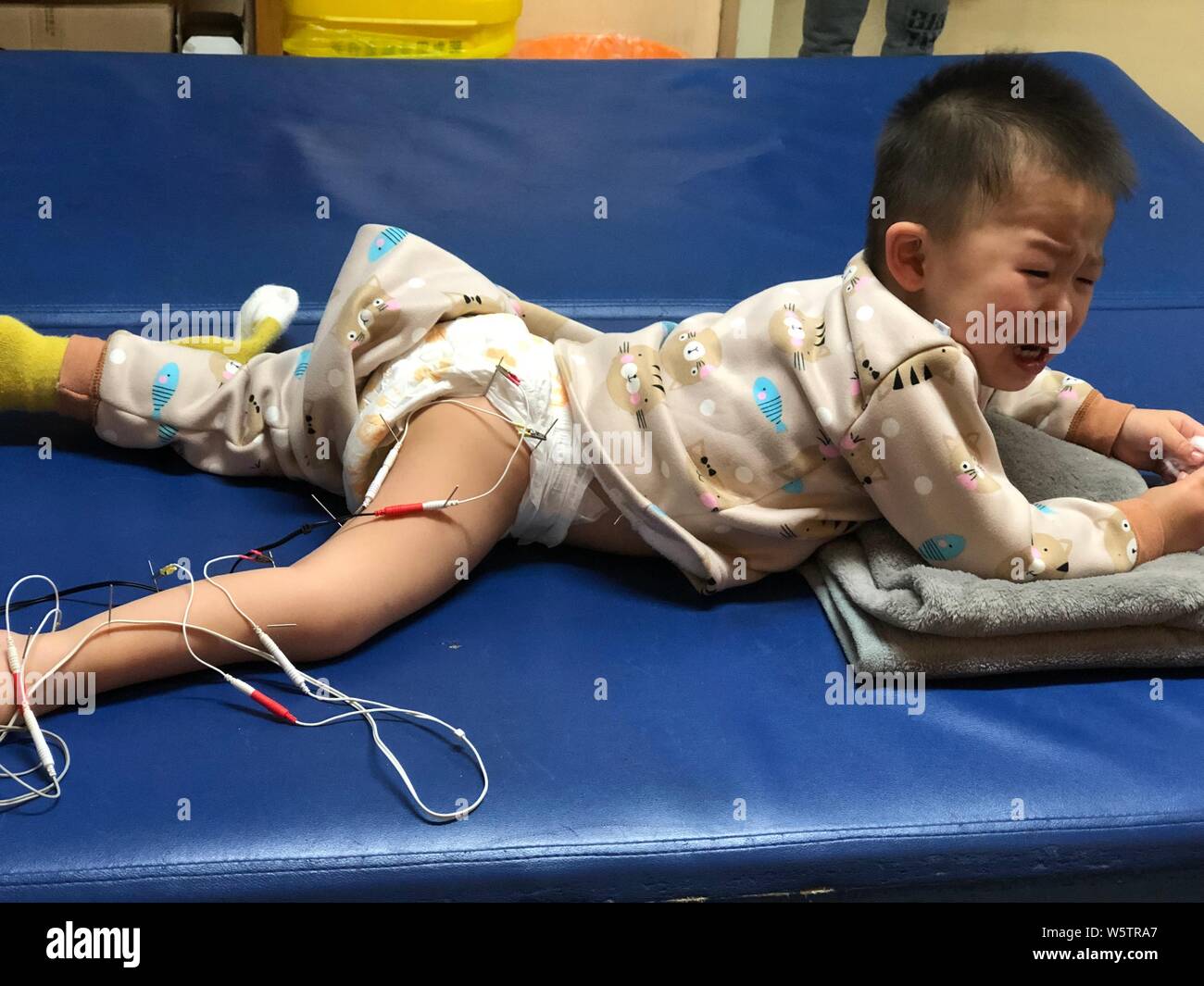 2-jährige Körperbehinderte baby Wenbo aus dem südlichen China Qingyuan Stadt bestimmt mit Kinderlähmung und Paralytische poliomyelitis weint Stockfoto