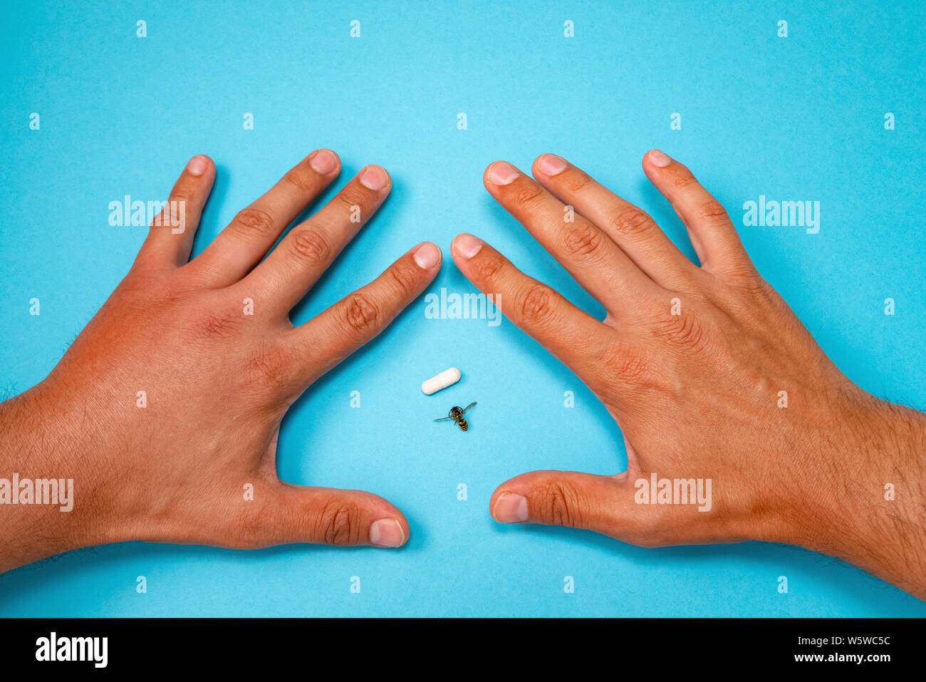 Männliche hand von Biene gestochen und Medikamente für Sie Schwellungen. Hand, Schwellungen, Entzündungen, Hautrötungen sind Anzeichen einer Infektion. Insekt beißt und Pillen auf b Stockfoto