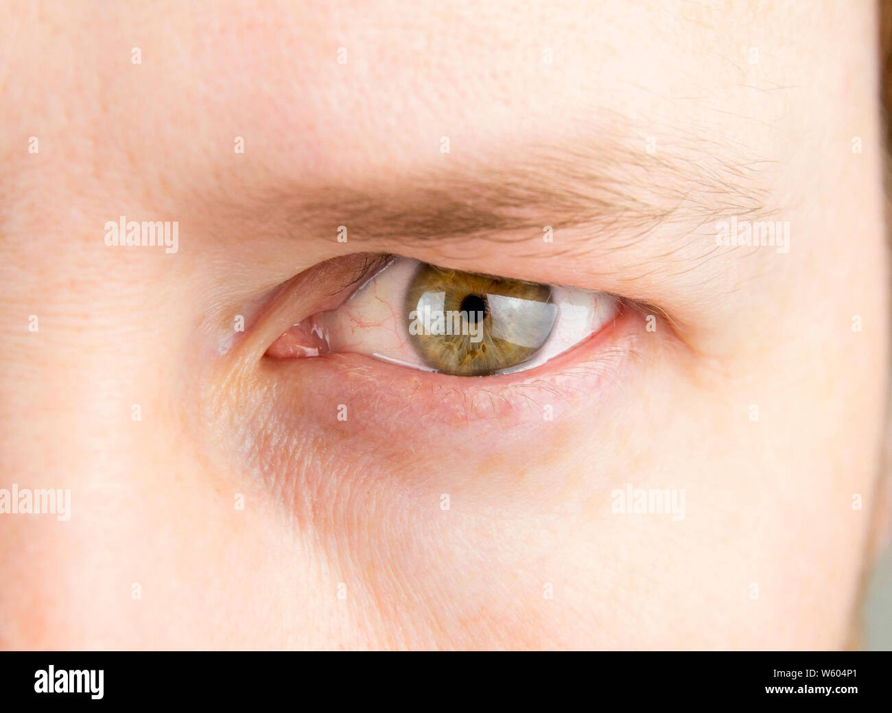 Detailansicht der Mensch grüne Auge mit schweren Oberlid. Vor Blepharoplastik Operation Dermatochalasis Konzept. Stockfoto