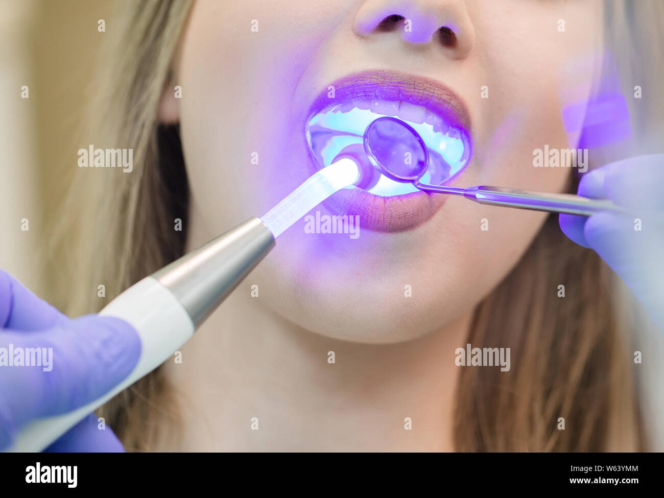 Zahnarzt tun Verfahren mit zahnmedizinischen Härtung mit UV-Licht in der Klinik Stockfoto