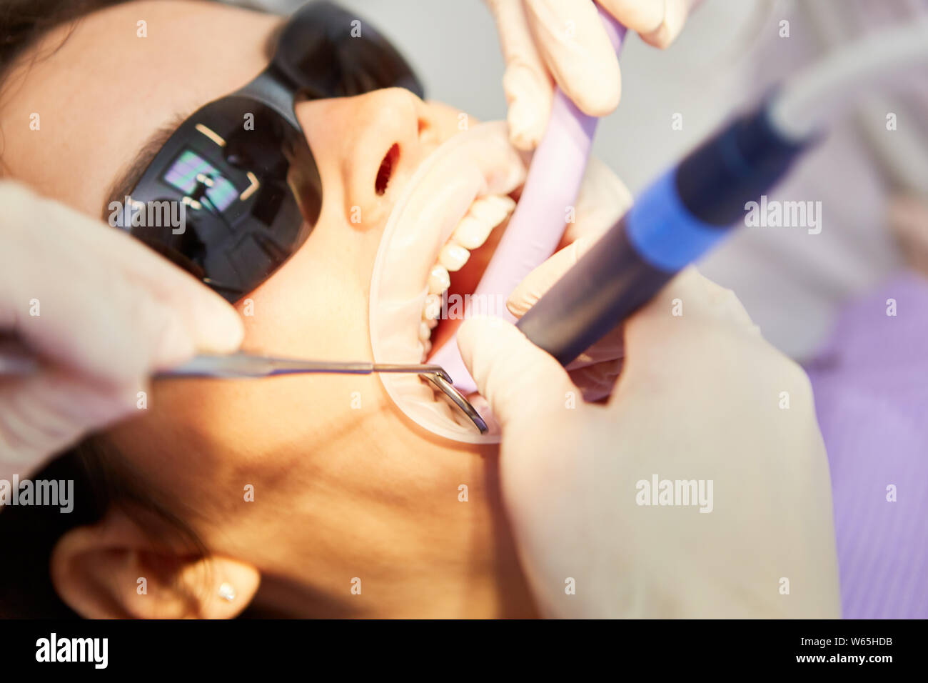 Zahnarzt mit dem Bohrer an eine Wurzelkanalbehandlung in der zahnmedizinischen Klinik oder Praxis Stockfoto
