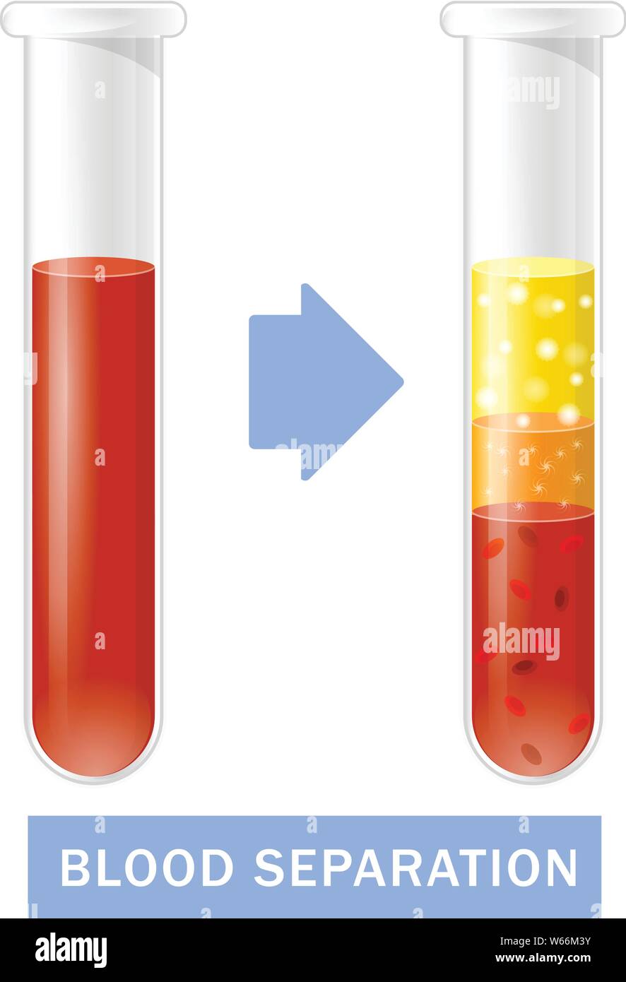 Reagenzglas mit Blut nach der Trennung von Thrombozyten, PRP Infografiken, platelet-rich Plasma Stock Vektor