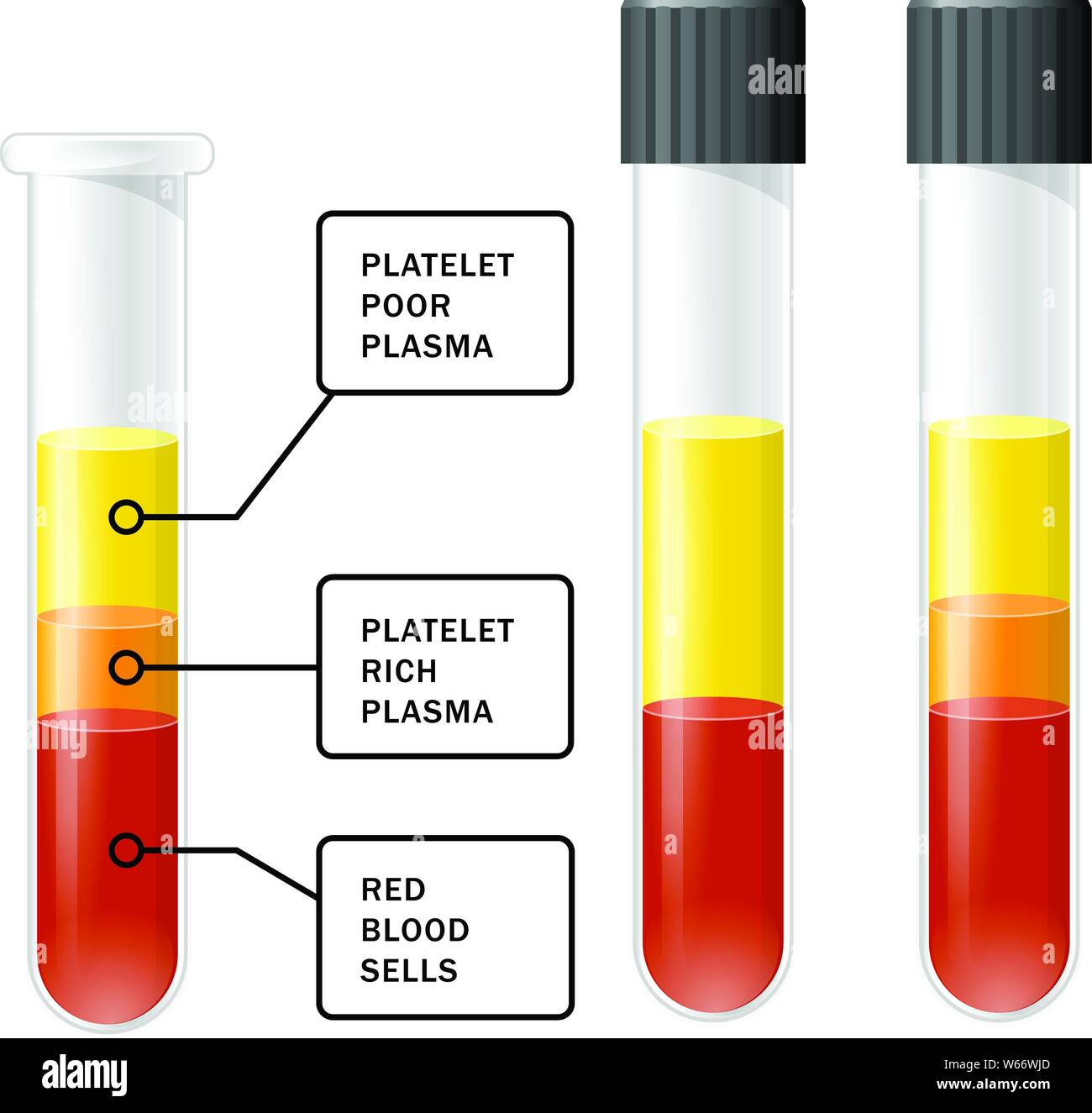 Blut nach der Trennung von Thrombozyten in der Zentrifuge im Reagenzglas, PRP Infografiken, platelet-rich Plasma Stock Vektor