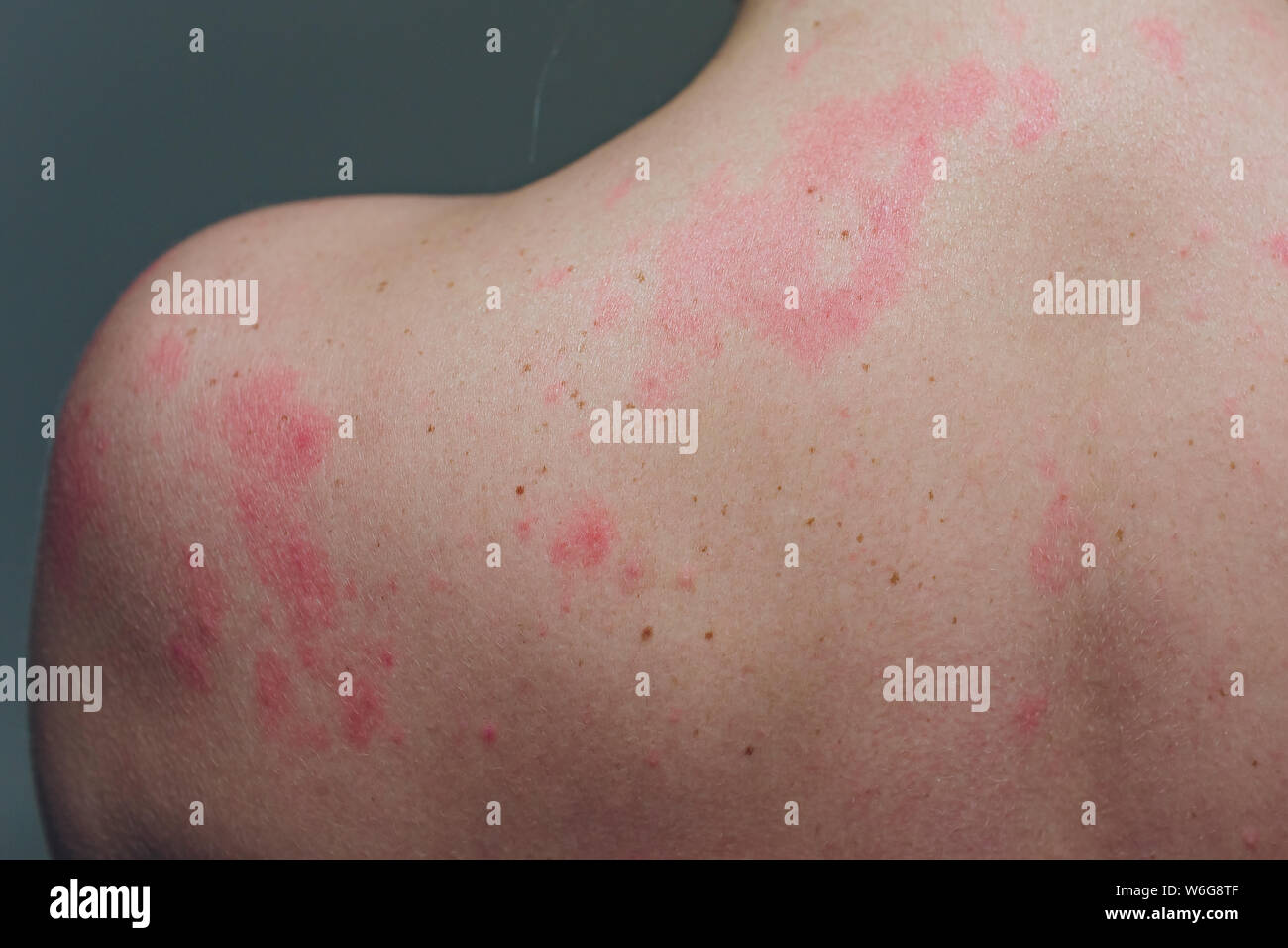 Close up Allergie Hautausschlag, um die Rückseite des menschlichen mit Dermatitis Problem der Ausschlag, Allergie Hautausschlag und gesundheitliches Problem. Stockfoto