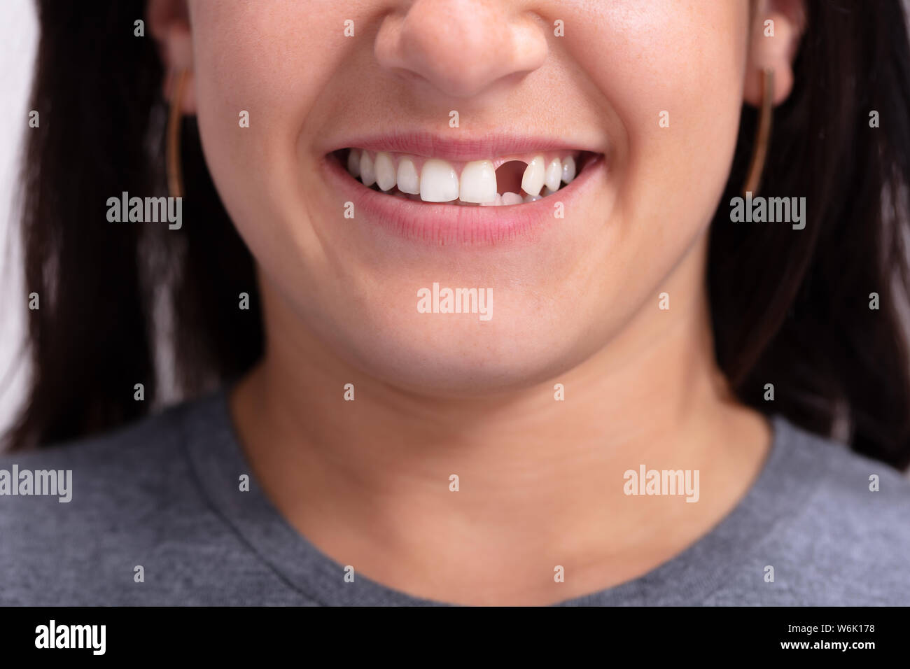 Schließen Sie herauf Foto der jungen Frau mit fehlenden Zahn Stockfoto