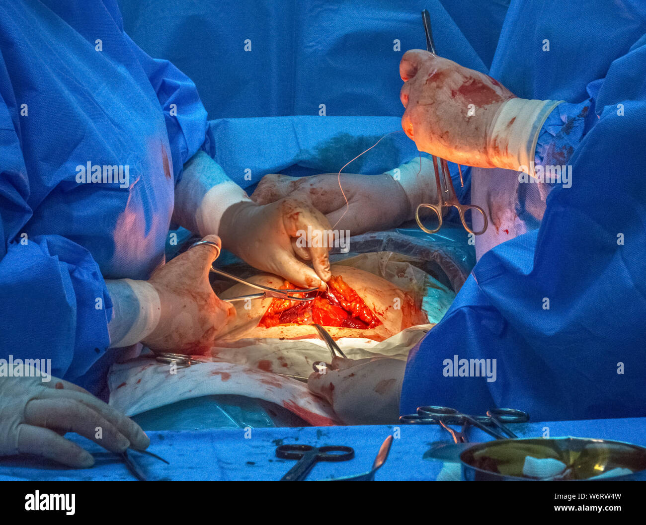 Arzt Praxis Team im Operationssaal der Abdominal- Kaiserschnitt bei der Geburt eines Kindes. Stockfoto