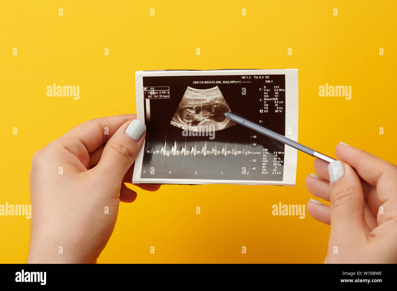 Kontrolle der schwangeren Frau baby per Ultraschall im Krankenhaus Stockfoto