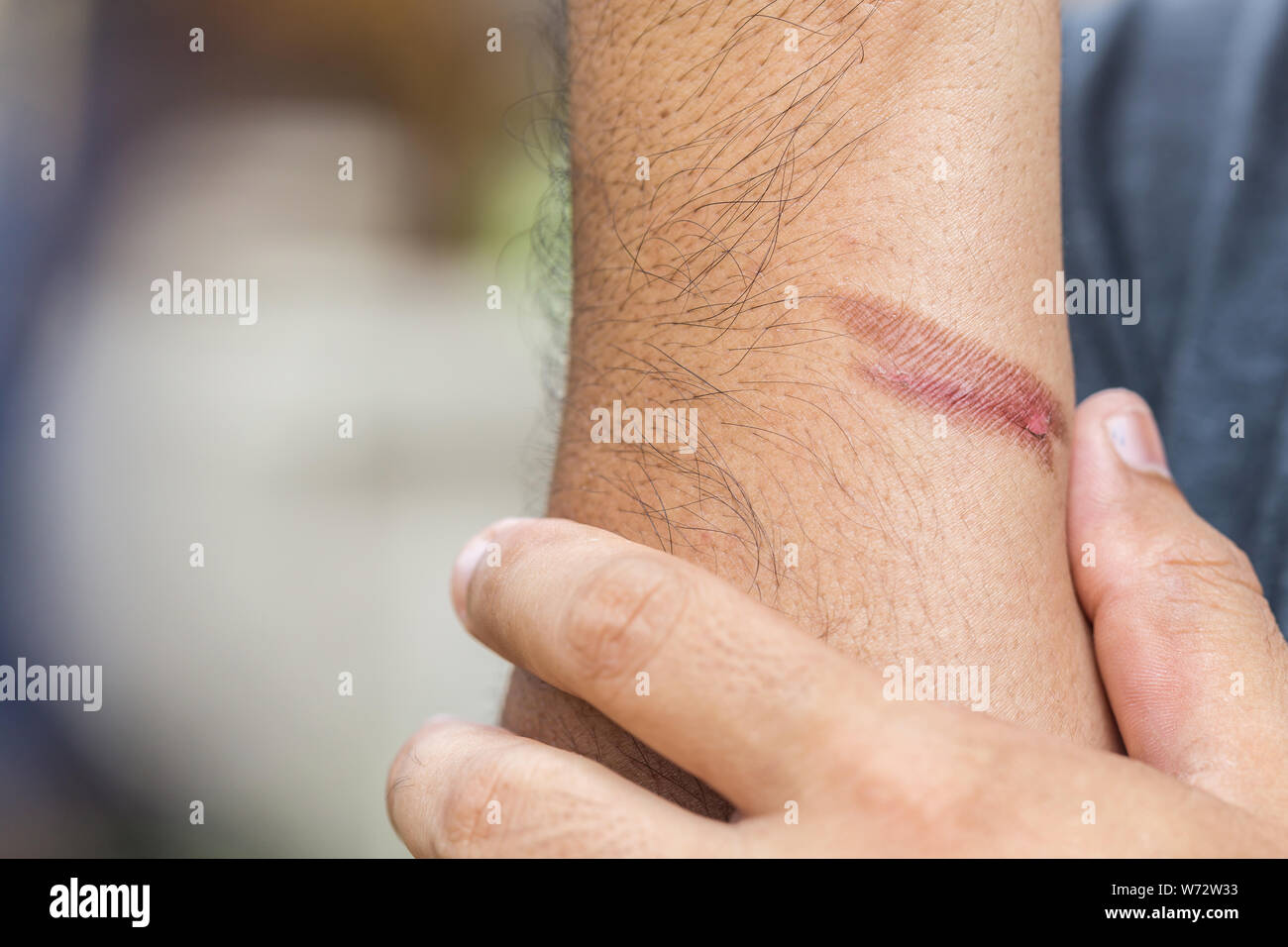 Nahaufnahme, brennende Haut am Arm, Verletzungen durch Feuer Stockfoto