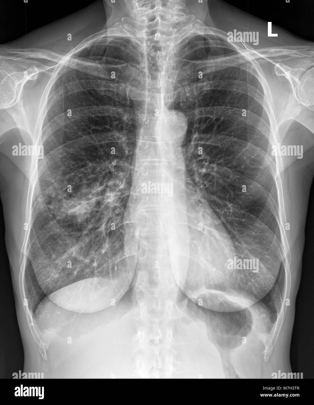 X-ray der weiblichen Brust am Freitag, 26. Juli 2019. (© Frances M. Roberts) Stockfoto