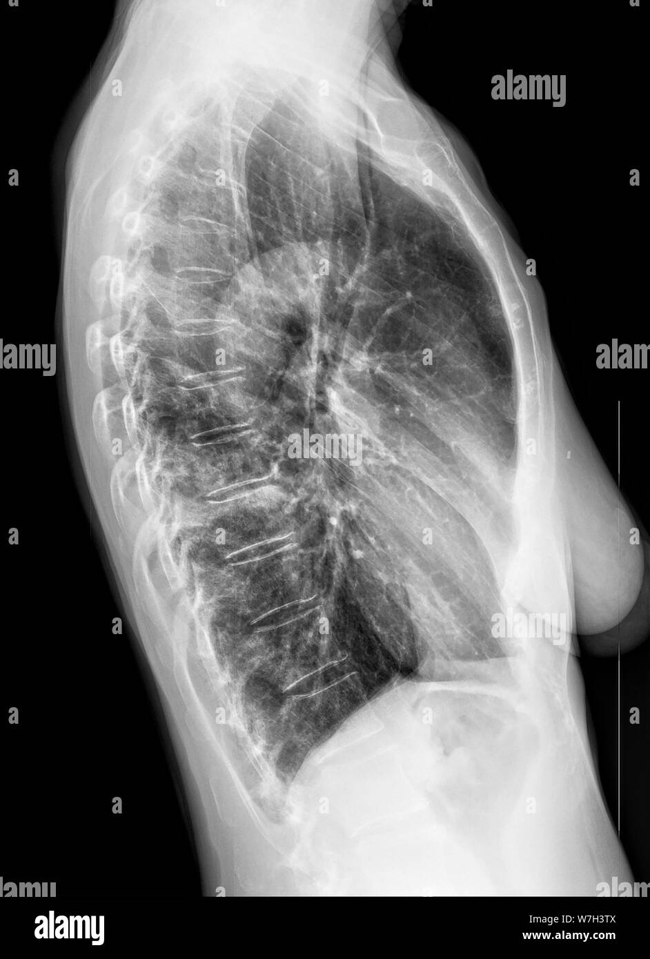 X-ray der weiblichen Brust am Freitag, 26. Juli 2019. (© Frances M. Roberts) Stockfoto
