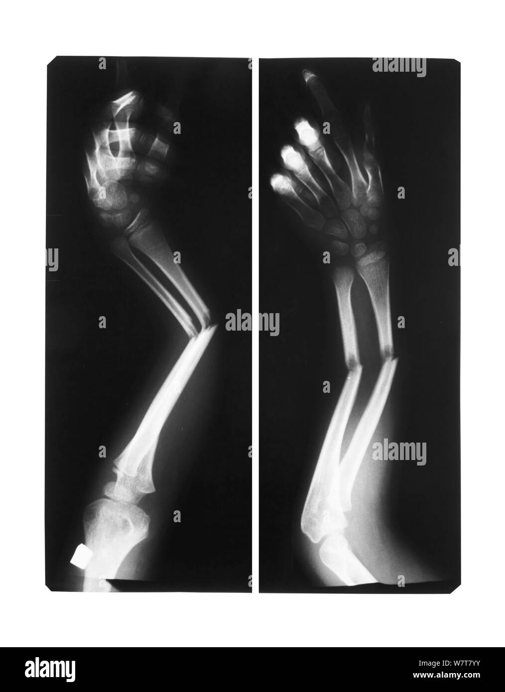 Film x-ray Unterarm AP: Zeigen die doppelten Bruch der Welle des ulnarorforearm Knochen Stockfoto