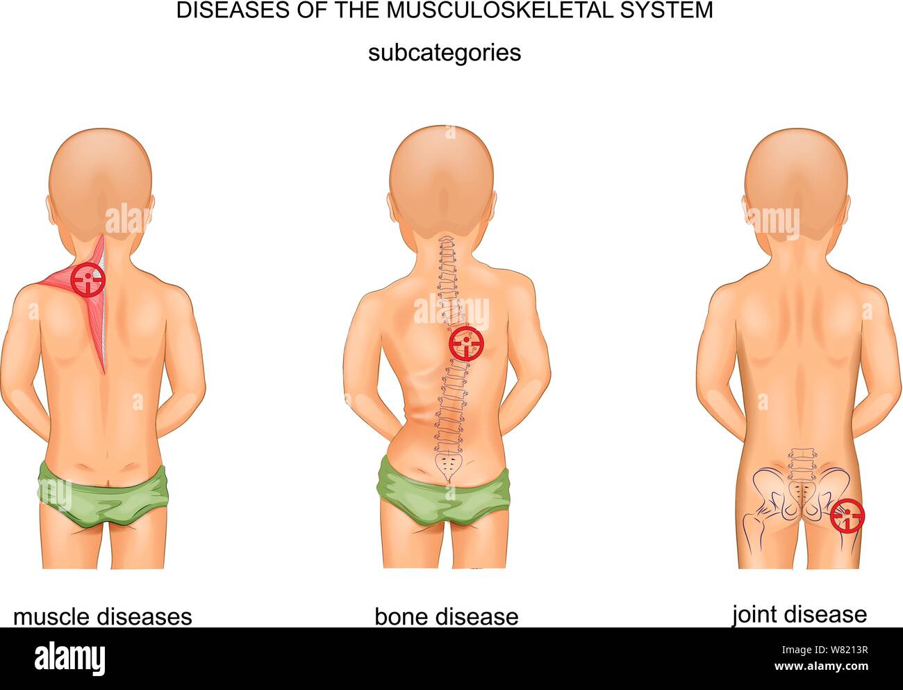 Vector Illustration von Erkrankungen des Muskel-Skelett-Systems Stock Vektor