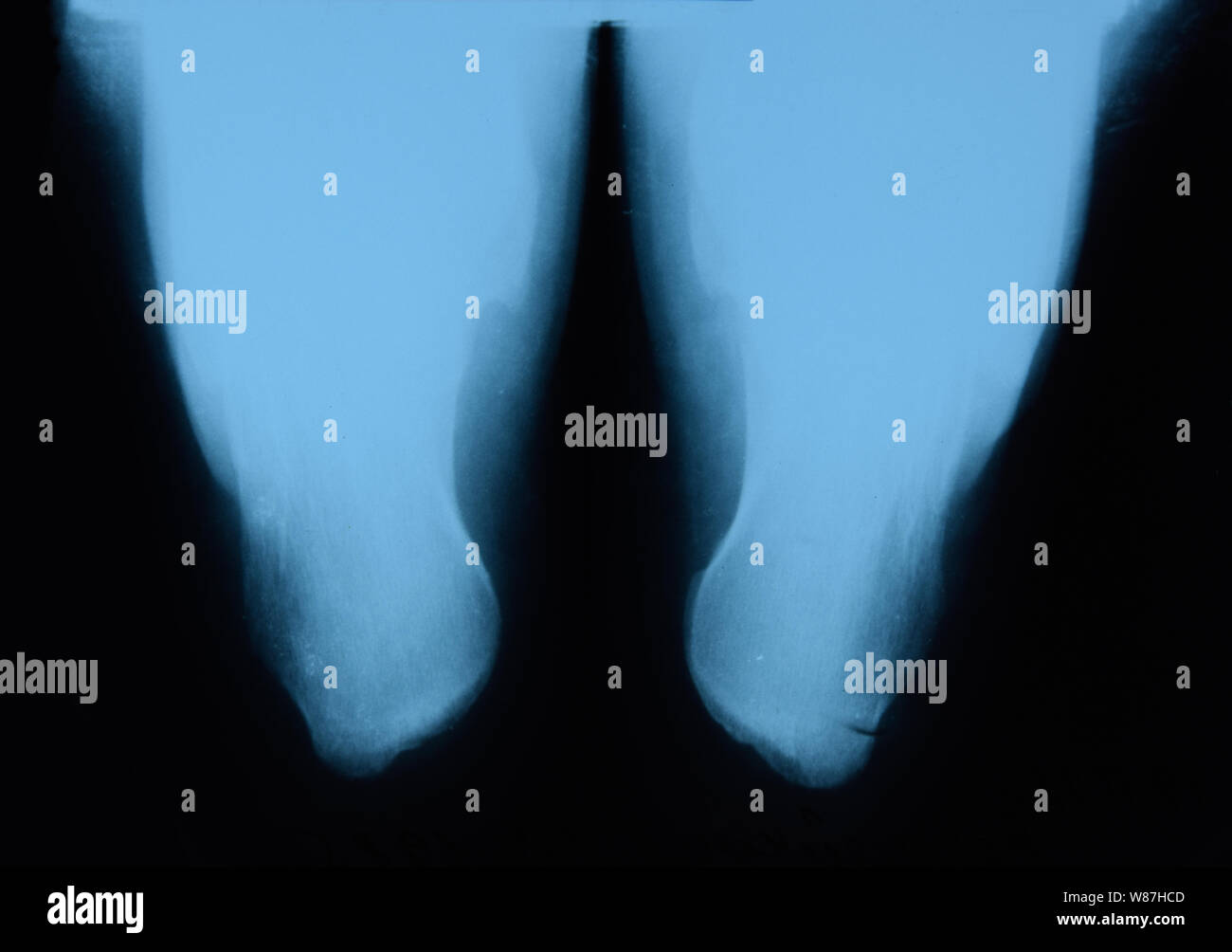 X-ray von Fuß und Ferse Knochen. X-ray Bild von Knochen. Stockfoto
