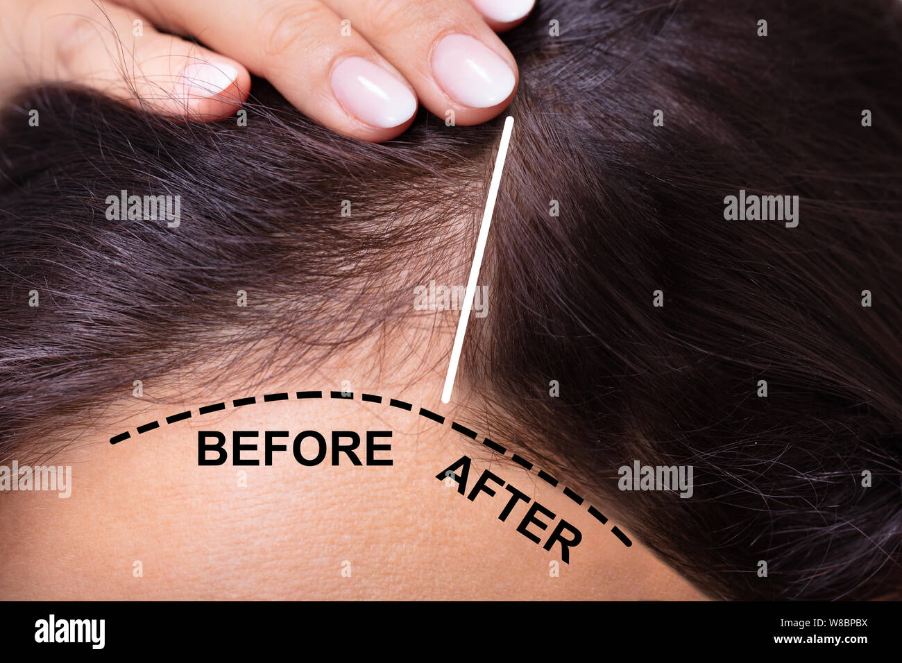 Frau vor und nach der Behandlung gegen Haarausfall Stockfoto