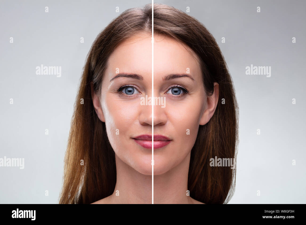 Nahaufnahme von einer jungen Frau, Gesicht vor und nach der kosmetischen Verfahren Stockfoto