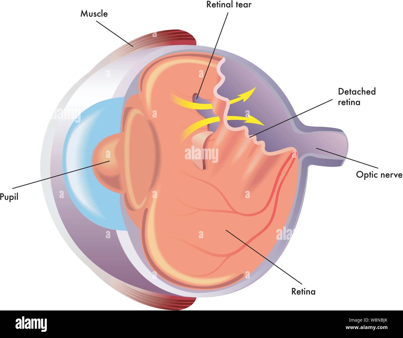 Medizinische Illustration der Auswirkungen der Netzhautablösung Stock Vektor