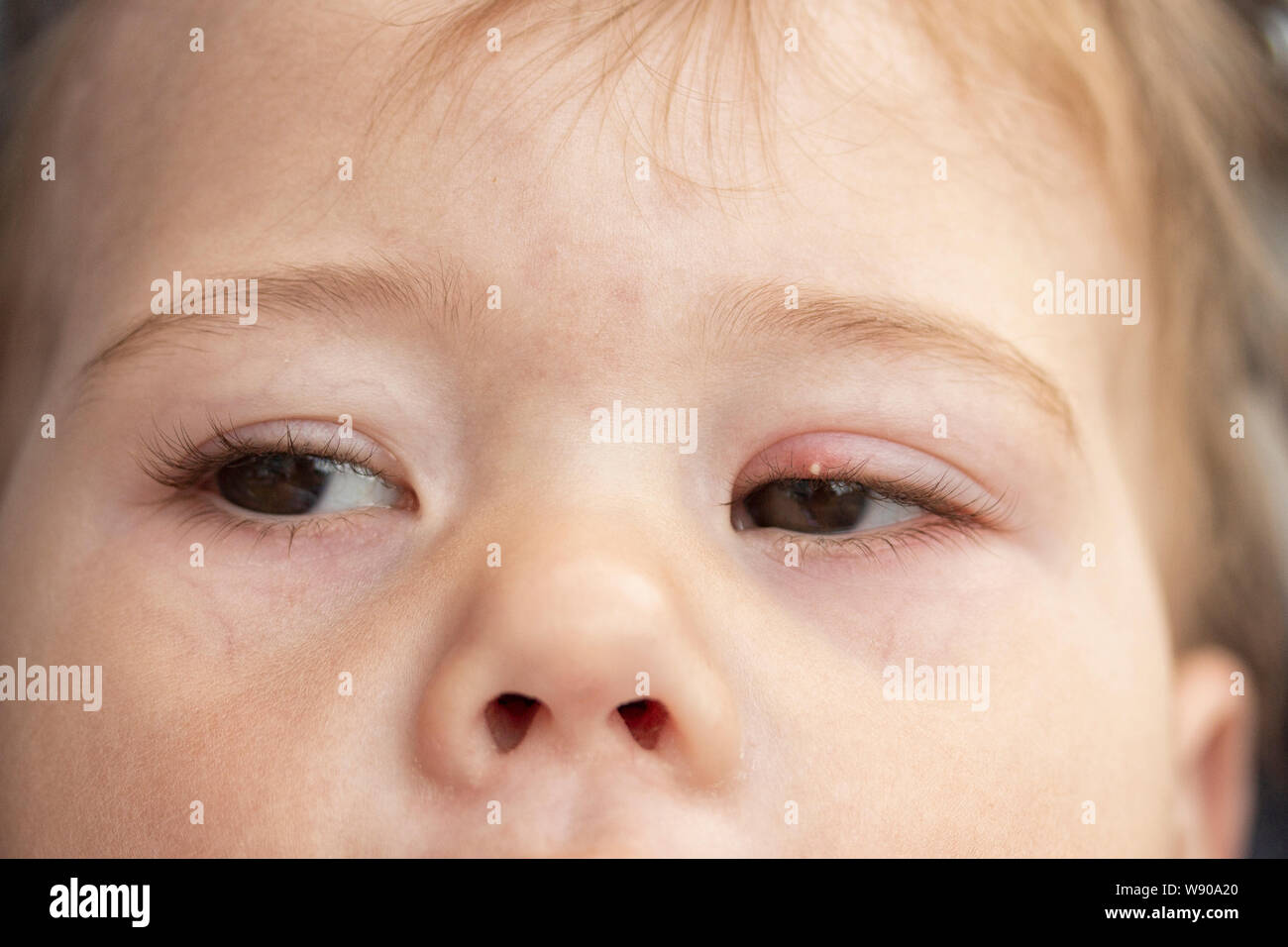 Weiße Pickel auf oberlid von Auge. Entzündung des Auges eines kleinen Baby Kind, Konjunktivitis. Milium ist eine kleine, Harte, hellgelbe keratinous Knötchen fo Stockfoto