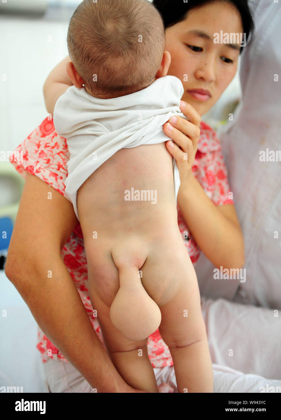 Die sieben Monate alte Kind, hat einen kleinen Schwanz - wie Tumor am Ende seiner Wirbelsäule durch seine Mutter in einem Krankenhaus in Guangzhou gehalten wird, südost China Stockfoto