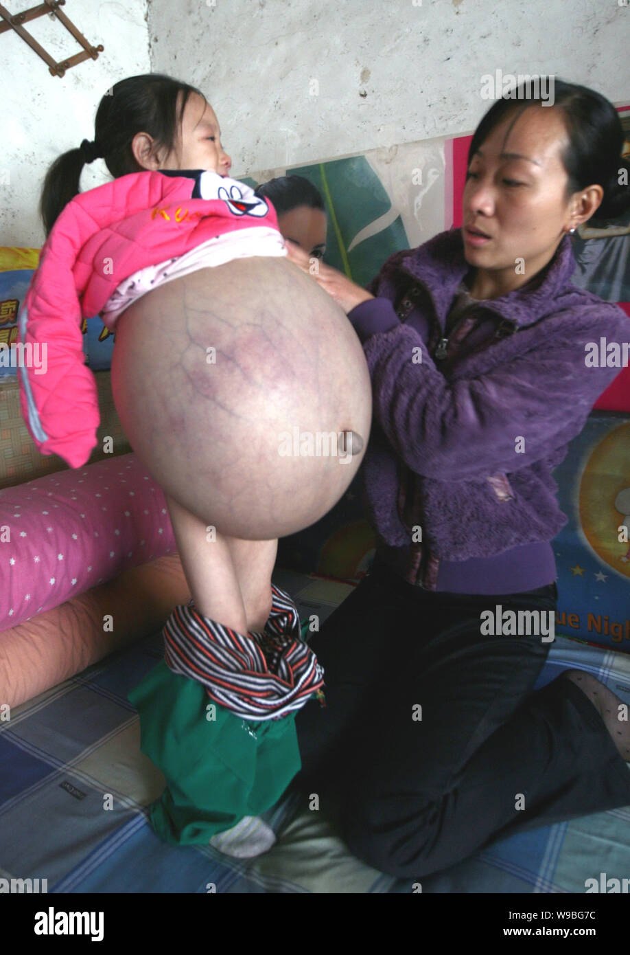 Hu Yunxing (links), ein 4-jähriges Mädchen, dessen Bauch misst 1,06 m im Umfang, ihr Bauch zeigt an einem Haus in Xuzhou City, East China Sha Stockfoto