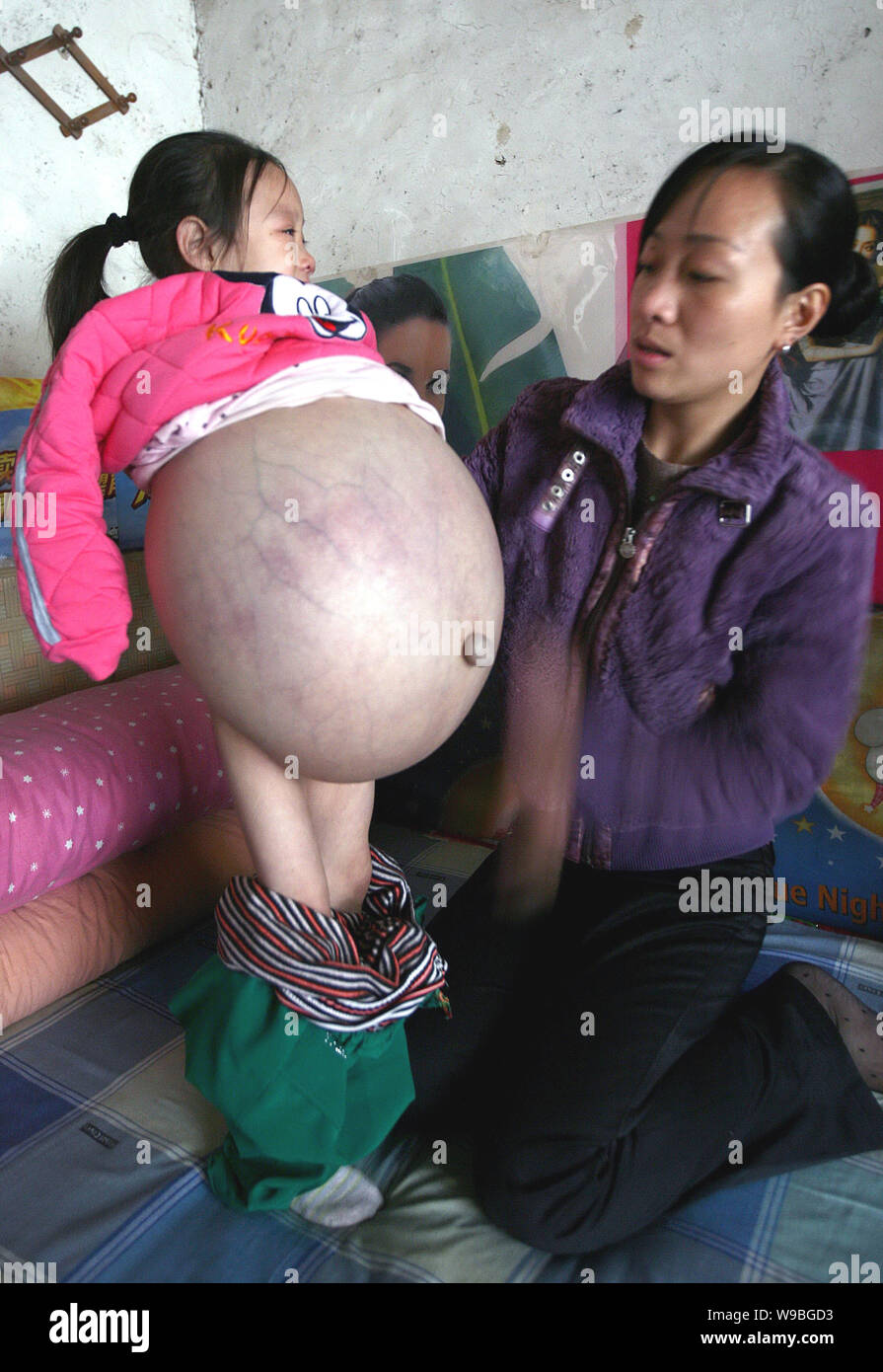 Hu Yunxing (links), ein 4-jähriges Mädchen, dessen Bauch misst 1,06 m im Umfang, ihr Bauch zeigt an einem Haus in Xuzhou City, East China Sha Stockfoto