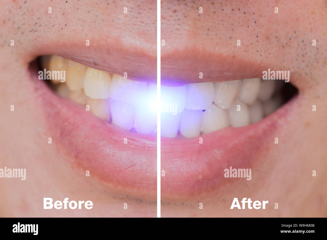Vor und nach der Bleichen und in den männlichen Bleichen von Zähnen für Kaffee oder Zigarette Flecken entfernen. Stockfoto