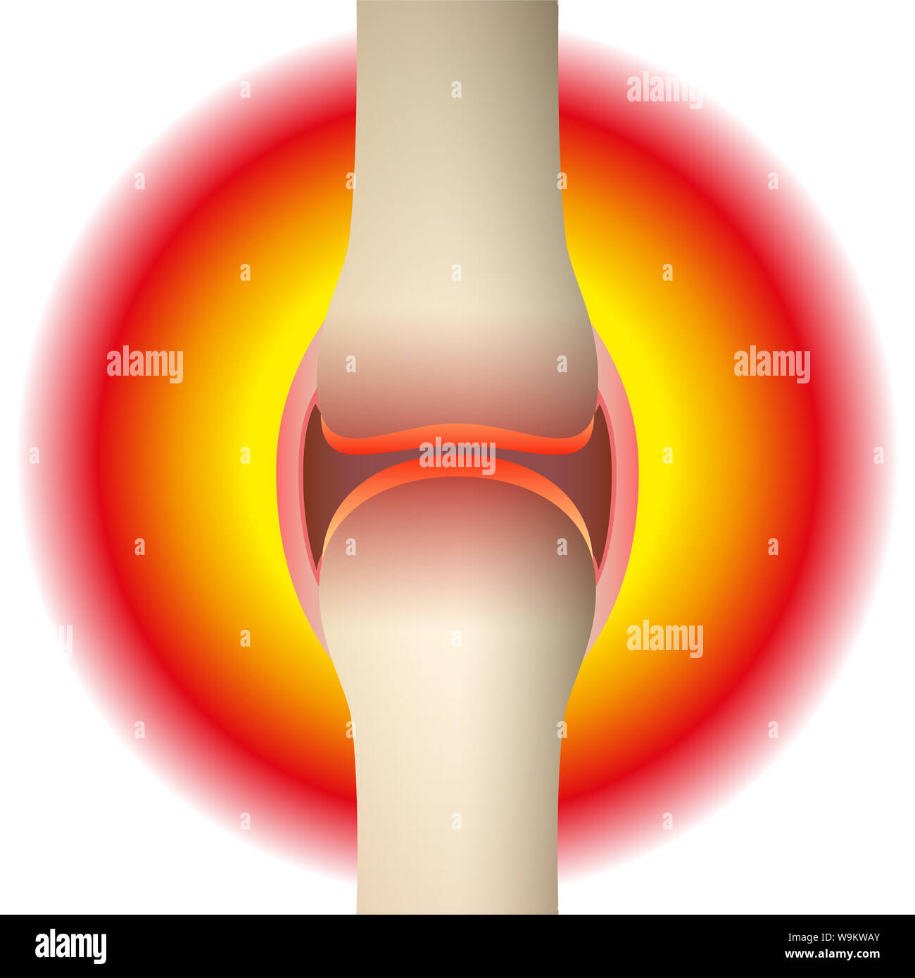 Gelenkschmerzen - schematische Darstellung der anatomischen Graphik eines synovial Joint mit Arthritis, Rheuma, Gicht, Arthrose oder Entzündung. Stockfoto