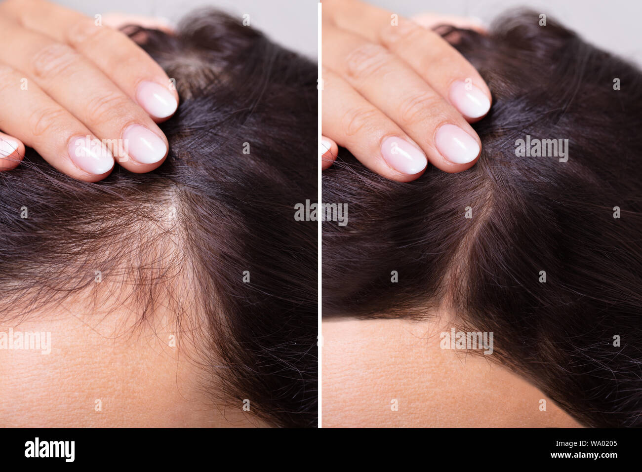 Frau vor und nach der Behandlung gegen Haarausfall Stockfoto