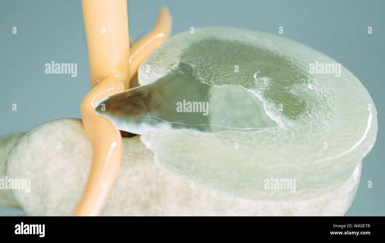 Wirbelsäule Bandscheibenvorfall so nahe wie 3D-Rendering Stockfoto
