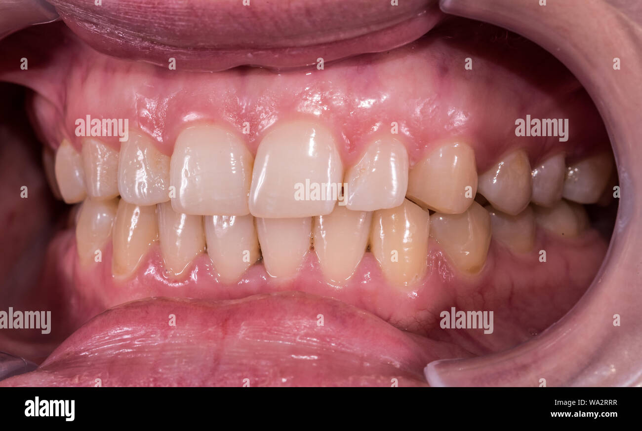 Gesunde menschliche Zähne mit normaler Okklusion aus Seitenansicht Stockfoto