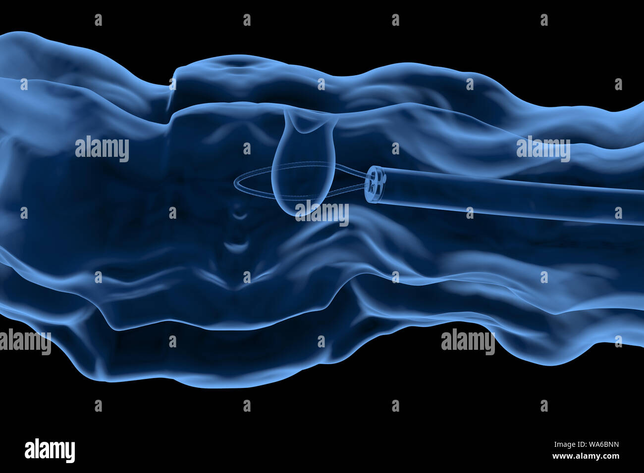 3D-Rendering x-ray Endoskop colonic Polyp mit Drahtschleife entfernen Stockfoto