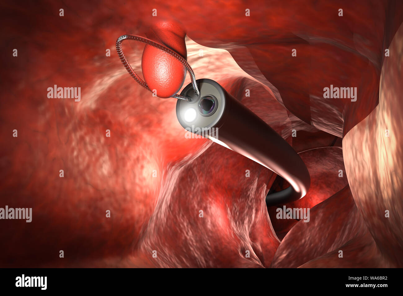 3D-rendering Endoskop colonic Polyp mit Drahtschleife entfernen Stockfoto