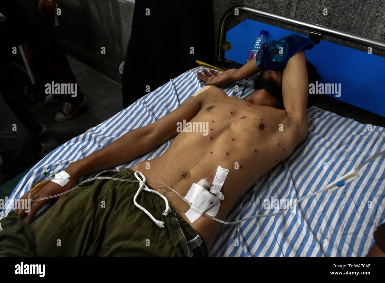 Eine verletzte Kaschmir Demonstrant Festlegung auf ein Bett im Krankenhaus während der Ausgangssperre in Srinagar. strengen Sperrstunde und insgesamt die Kommunikation Blackout in Kaschmir valley Nach der Entscheidung durch die zentrale Regierung, Artikel 370 Die besondere Status in Jammu und Kaschmir Zuschüsse zu verschrotten. Stockfoto